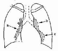原发性肺动脉高压
