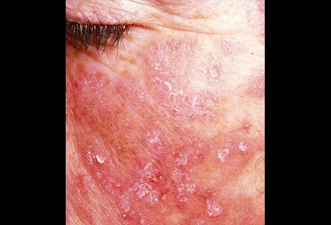 systemic lupus erythematosus